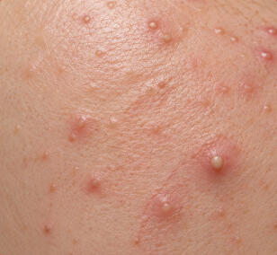 Hormonal Acne (Acne Vulgaris)