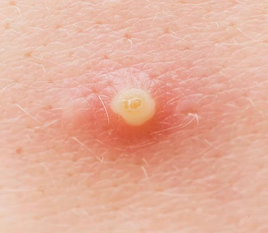 Standard Pimple (Pustule)