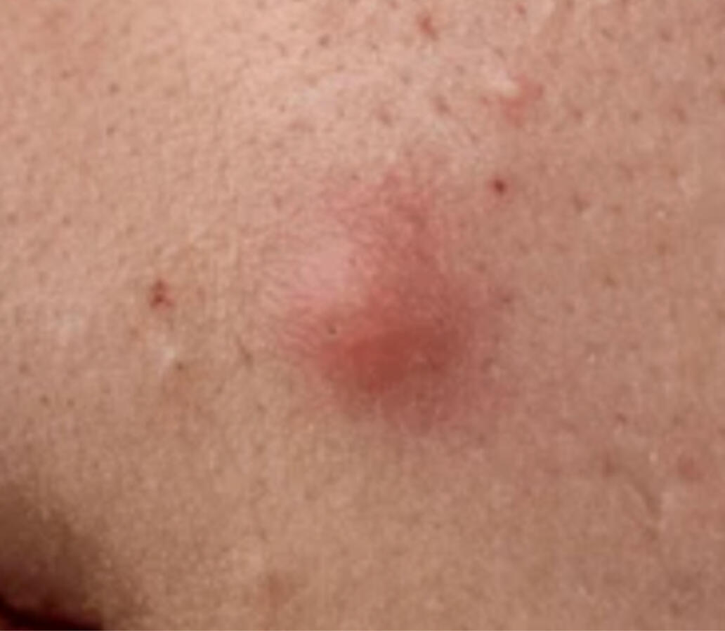 Blind Pimple (Papule)